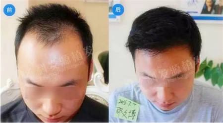 头发稀疏加密植发3076单位术后一年