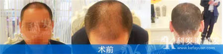 上海发友头发加密种植3200毛囊自述全过程