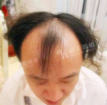 头发种植上海植发3838单位术后7个月