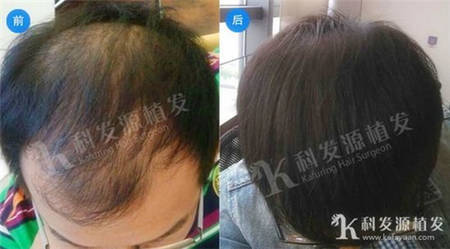 杭州头发种植4082单位术后一年效果
