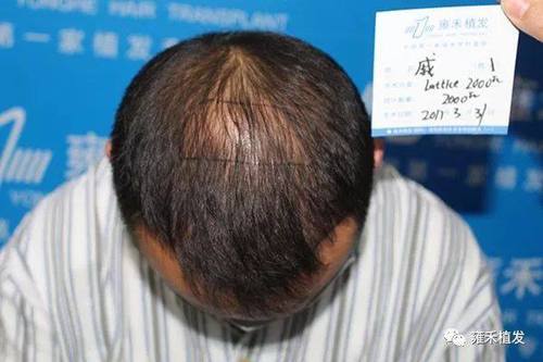 头发稀疏形象差植发加密2061单位半年效果