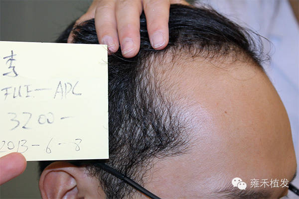 植发老案例额头很大植发3293单位1年植发效果
