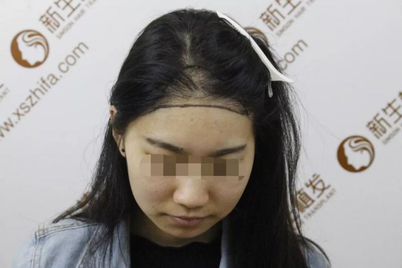 女士发际线种植4个月植发效果堪比整容