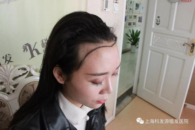 上海抖音小姐姐发际线调整植发改变大额头