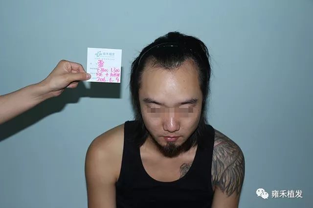 澳洲华人无痕植发10个月嬗变美男子