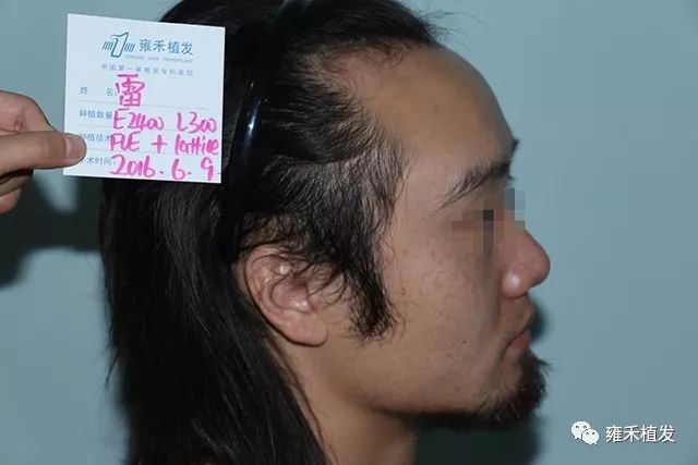 澳洲华人无痕植发10个月嬗变美男子