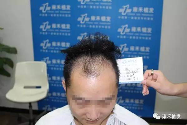 深圳植发3102单位把头发的失地统统收复