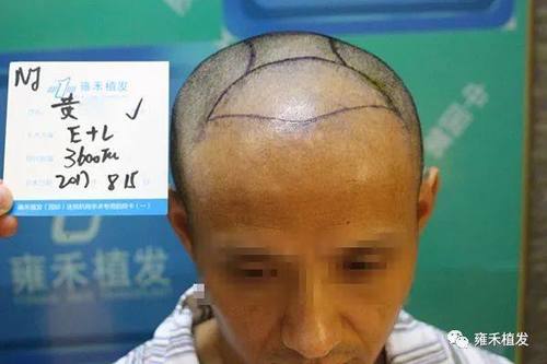 他在别的医院植发失败来进行修复植发