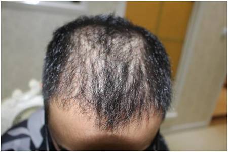 头发稀疏加密植发3525单位6个月后浓密