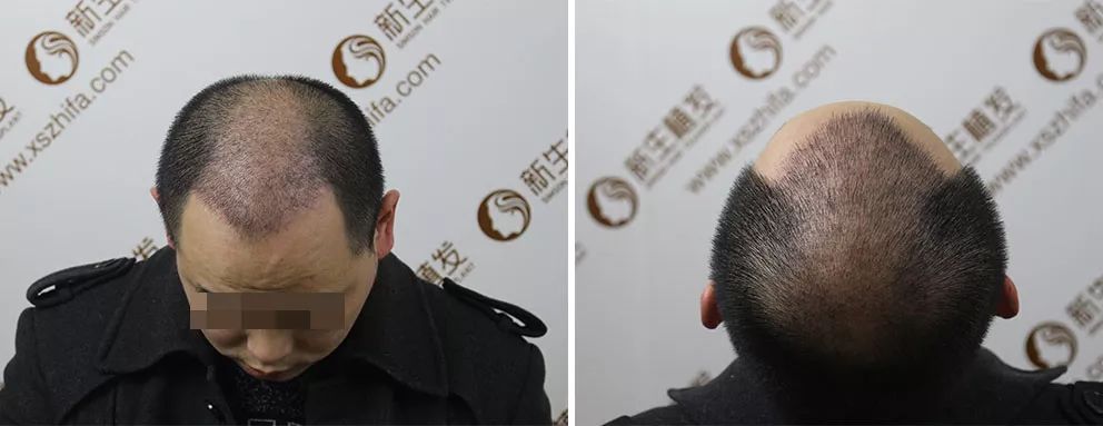 王先生秃顶植发4500单位术后效果这么好！