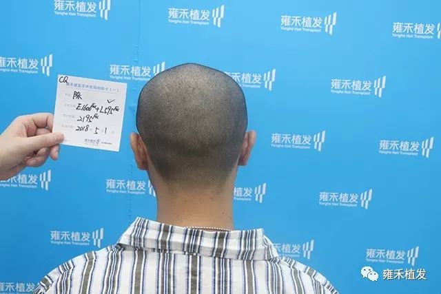 他剃了光头来重庆医院植发种2250单位7个月