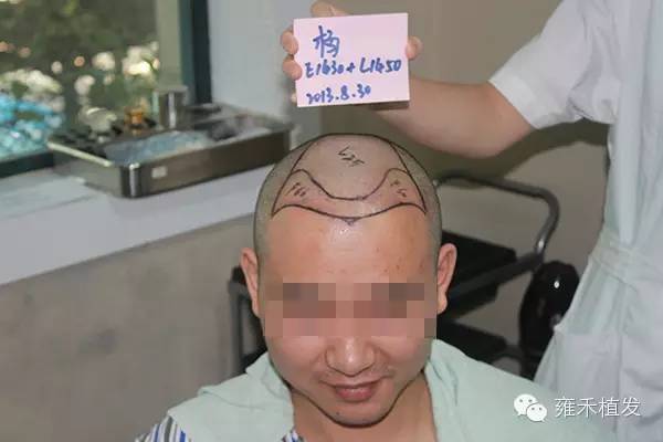 武汉植发2880单位8月植发效果头发形象逆袭