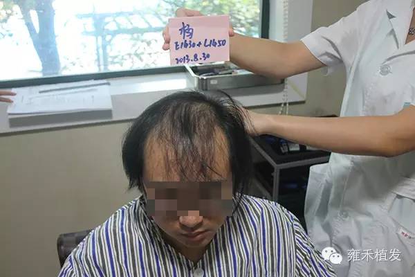 武汉植发2880单位8月植发效果头发形象逆袭