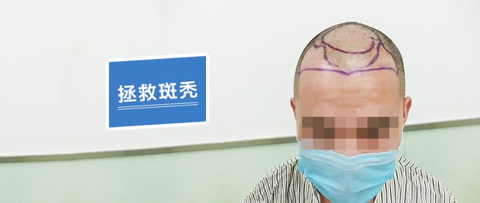 他是实习医生遭遇斑秃后做了头皮前部的毛发移植
