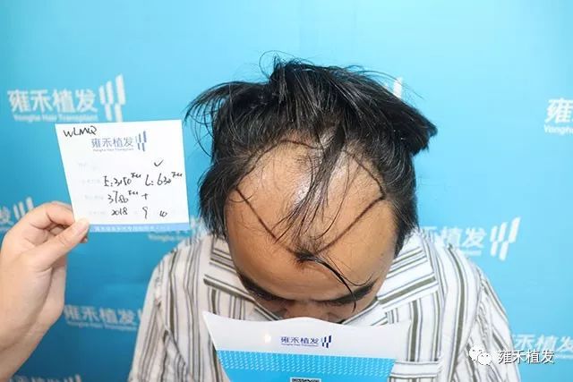 新疆警官5级脱发植发后效果好的说亚克西