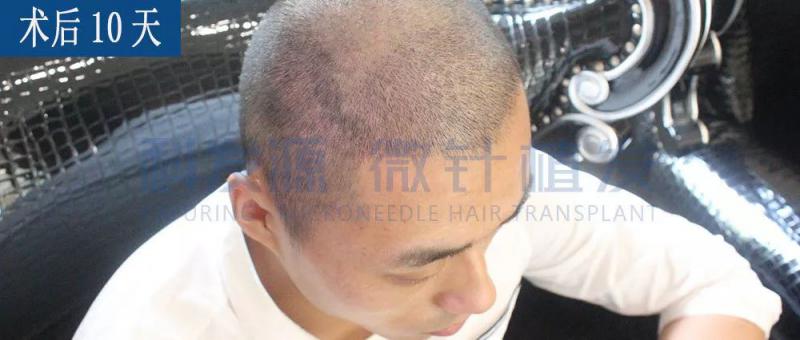 28岁发友为了头发在科发源上海分院做植发手术