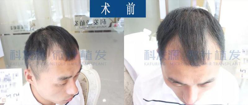 28岁发友为了头发在科发源上海分院做植发手术