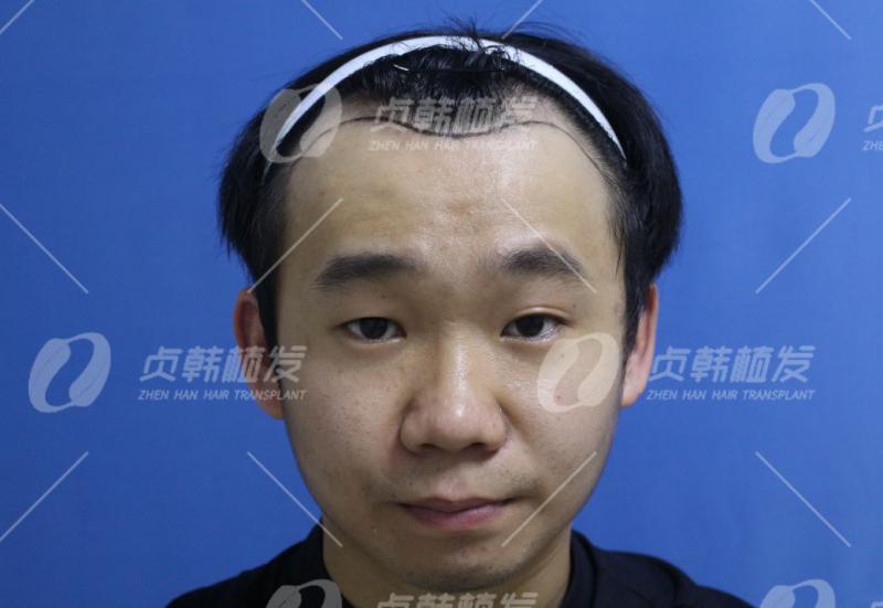 韩国专家说植发会更丑他不信邪偏要植发结果…