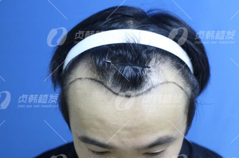 韩国专家说植发会更丑他不信邪偏要植发结果…