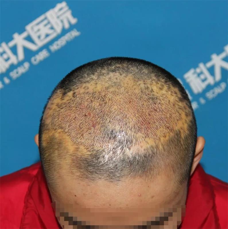 头顶大面积狰狞疤痕植发后疤没了人变自信了