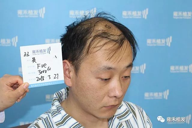 郑州先生秃顶植发3945单位1年大帅迷上自拍