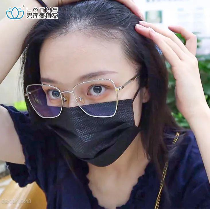 碧莲盛植发医院案例效果图美女发际线多高算正常？