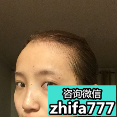 美女发际线移植