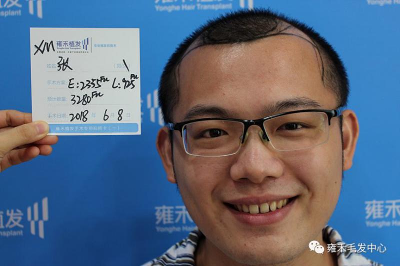 张先生在厦门雍禾做植发手术，总计种植3300毛囊单位