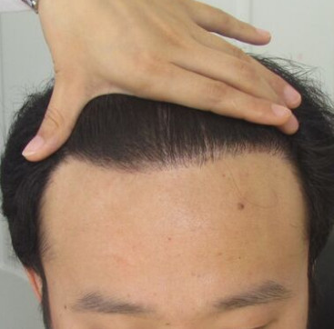 江西广济毛发移植中心做发际线种植真实案例