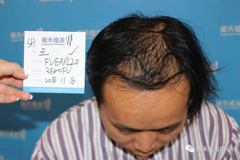 上海雍禾用FUE节约型植发为王先生种植3985单位