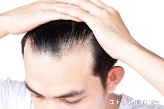 什么原因导致男生脱发？如何有效治疗？