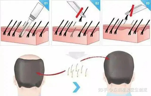 头上有疤痕可以植发吗？疤痕植发价格怎么样？