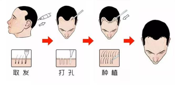 植发的技术原理和流程