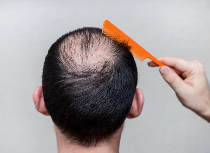 脱发是种痛！干细胞移植真的能解决脱发之困吗？