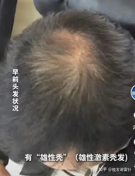 男子秃顶后求医无效，尝试半个月不用洗头竟长出头发