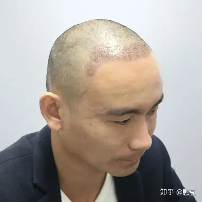 天津植发 男子头顶加密植发案例分享