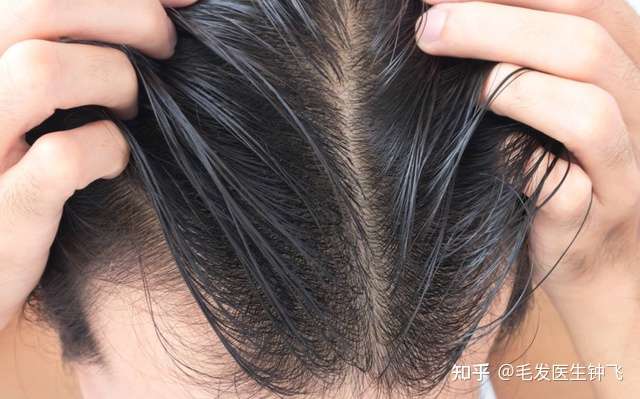 脂溢性脱发如何治疗？脂溢性脱发如何治疗？