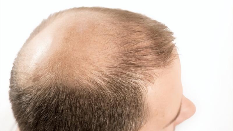 脱发会不会影响下一代？脱发要怎么治疗？