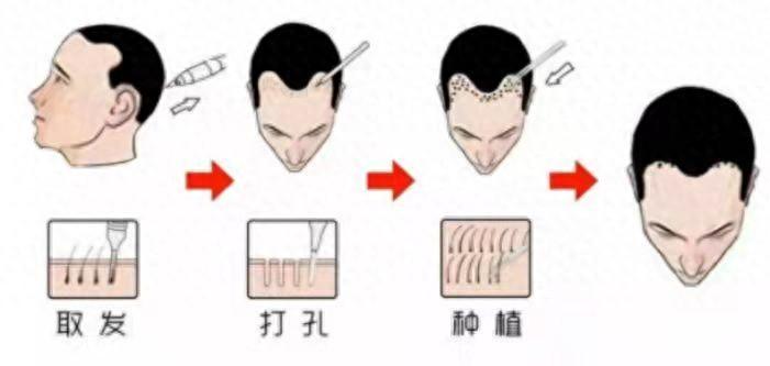 植发医院医生不会告诉你的真相！植发经典案例分享