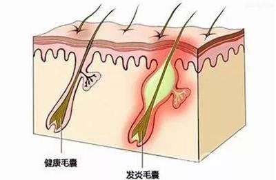 为什么有些头发掉了，再也长不出来了？