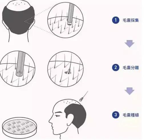 植发前，一定要知道的5大关键因素，让你少花几万冤枉钱