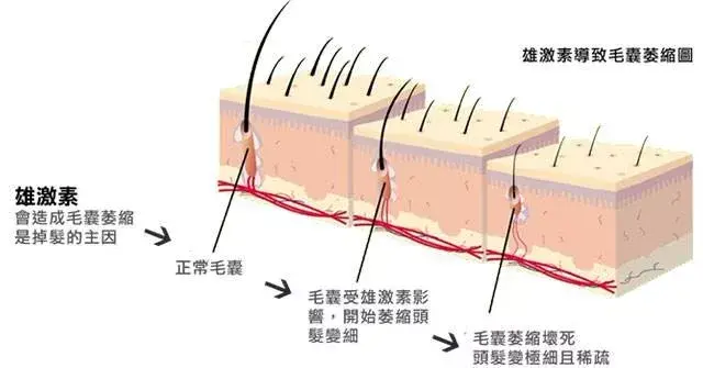 头发一天不洗就油？这是脂溢性脱发？