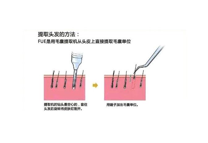 影响植发效果的重要原因之一：植发技术