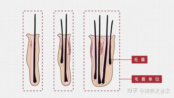 现在植发一般多少钱呢？