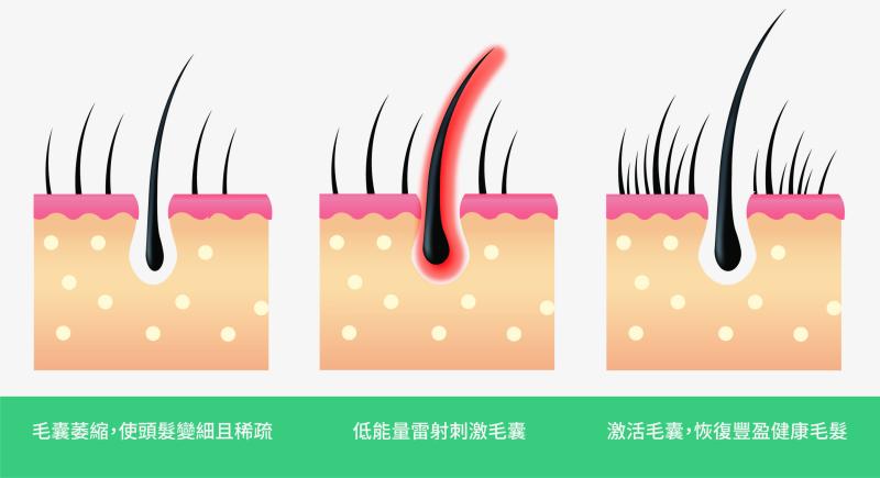 落髮治疗｜生髮、育髮、植髮 我到底适合哪一种？