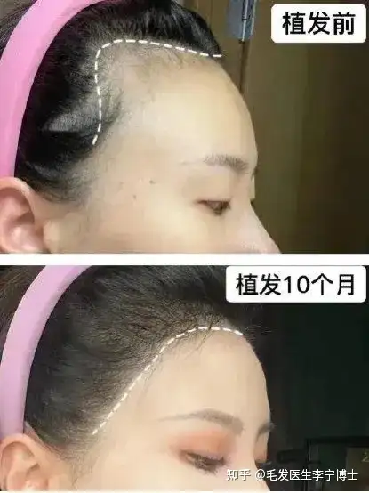 看看你的发际线需要拯救吗?