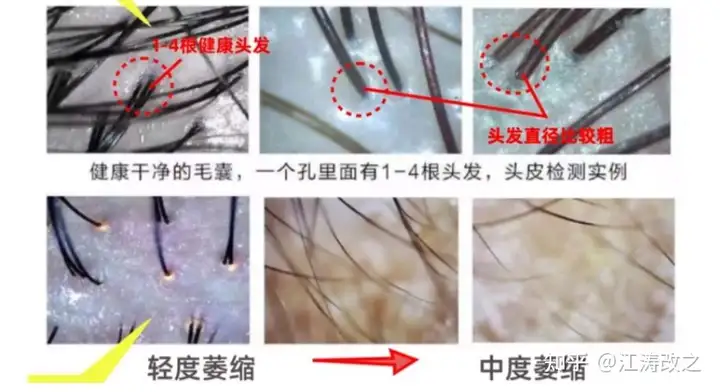 什么是毛囊闭合？关于毛囊闭合、遗传性脱发及治疗的详解