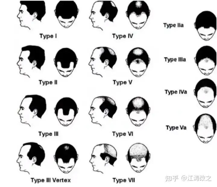 什么是毛囊闭合？关于毛囊闭合、遗传性脱发及治疗的详解