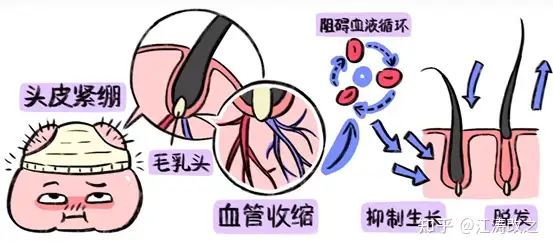 为什么大部分脱发只秃头顶和前额？