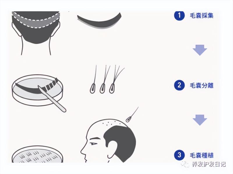 影响植发效果的因素是什么？植发的流程？